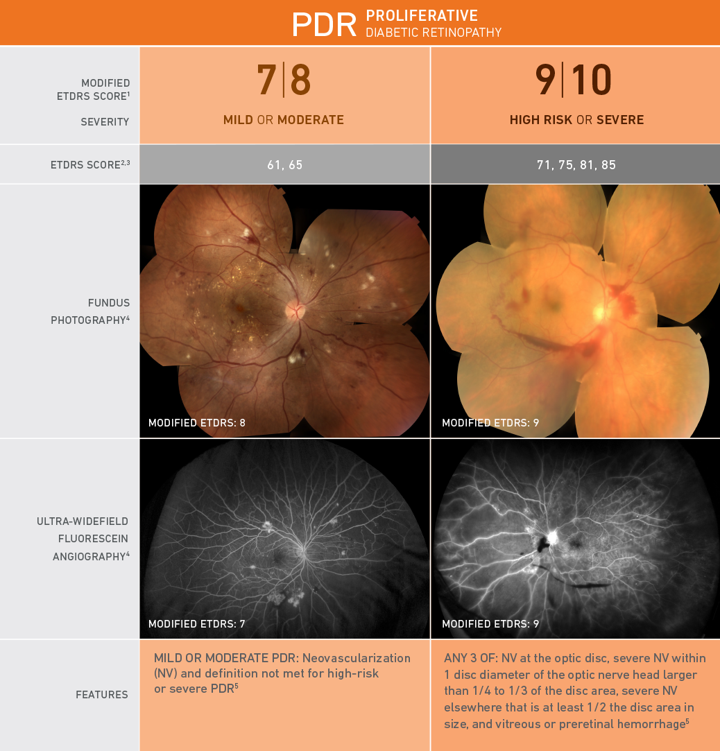 Proliferative Diabetic Retinopathy (PDR) disease features, ETDRS scores, and images; fundus photography, and ultra-widefield fluorescein angiography